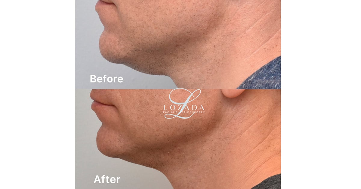Get a Chiseled Face With Facial Liposuction