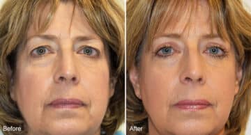 Blepharoplasty Before and After Photos in Philadelphia, PA, Patient 1280