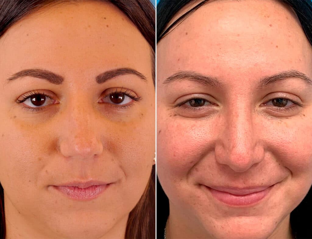 Bulbous Tip photos Becker Plastic Surgery