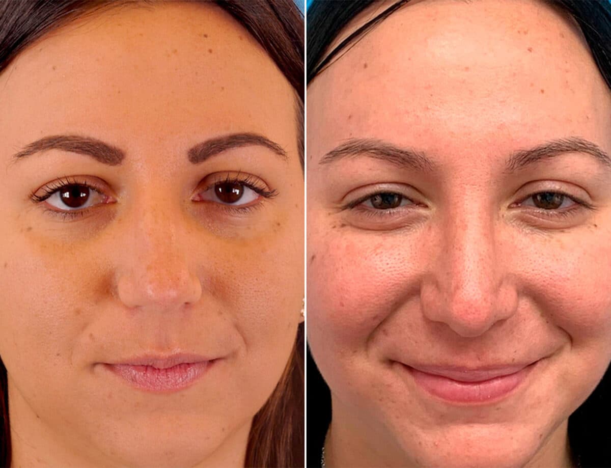 Patient 1769, Bulbous Tip Before and After Photos Bulbous Tip Before and After Photos in Sewell, NJ, Patient 1769