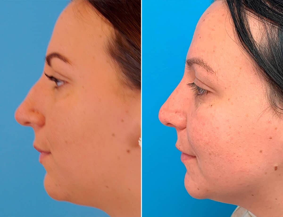 Bulbous Tip Before and After Photos in Sewell, NJ, Patient 1769