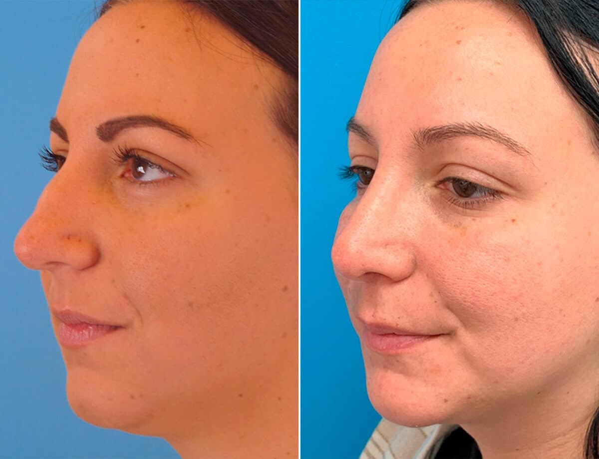 Patient 1769, Bulbous Tip Before and After Photos Bulbous Tip Before and After Photos in Sewell, NJ, Patient 1769