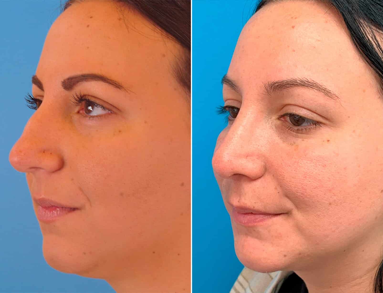 Bulbous Tip Photos Philadelphia, PA Patient 1769