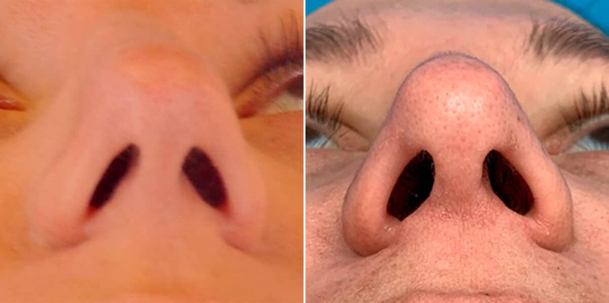 Bulbous Tip Before and After Photos in Sewell, NJ, Patient 1769