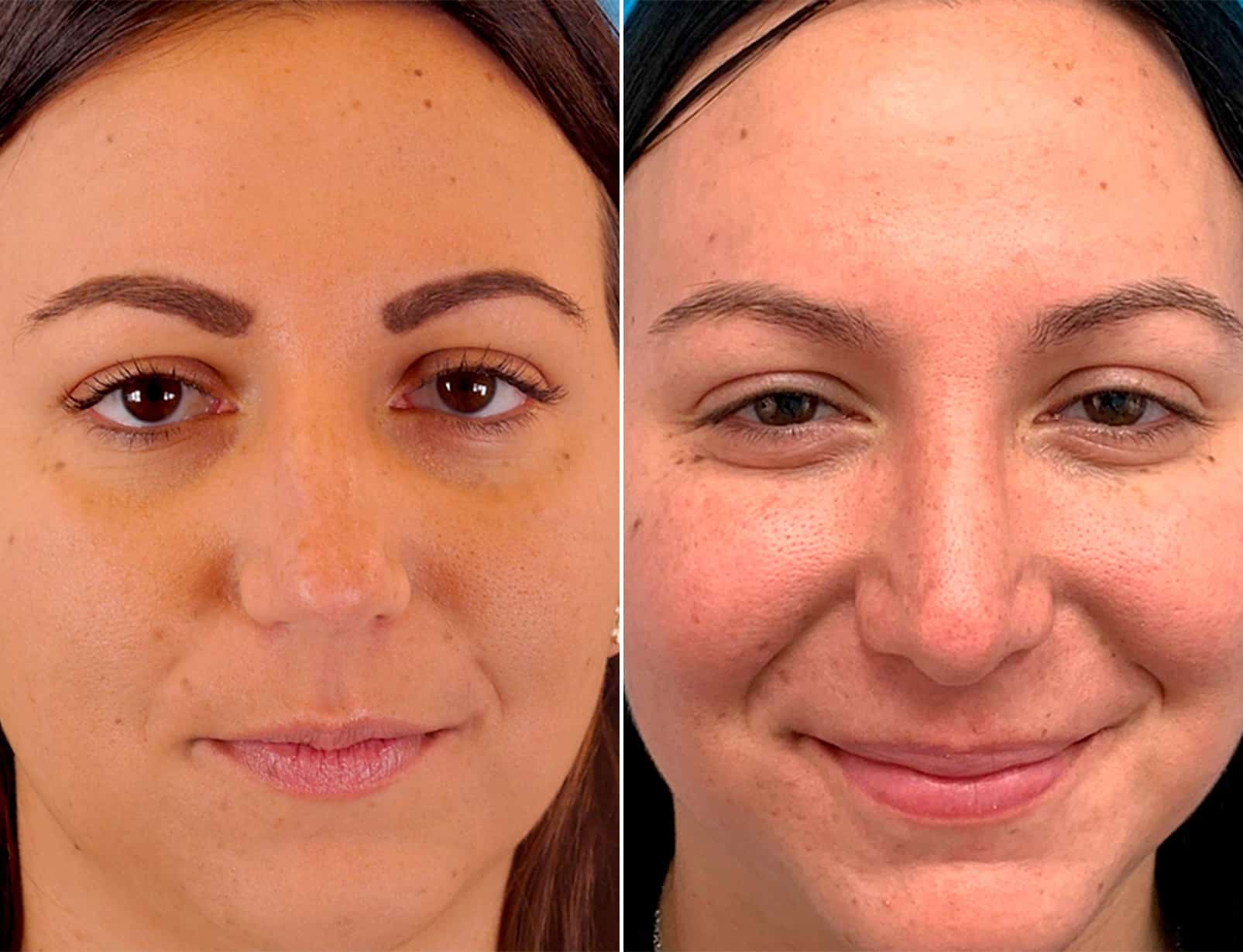 Bulbous Tip Photos Philadelphia, PA Patient 1769