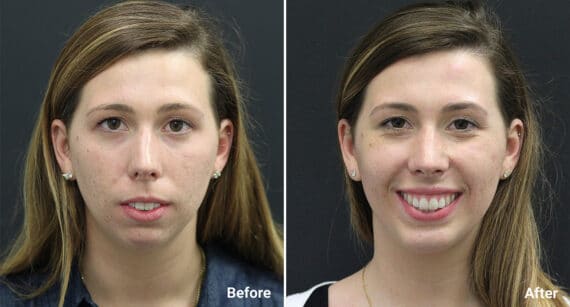 Chin Implants Before and After Photos in Princeton, NJ, Patient 831