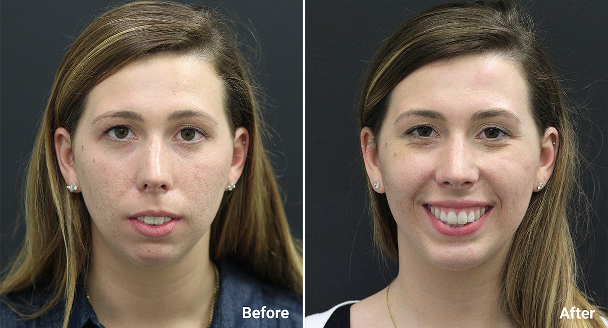 Chin Augmentation Before & After photos