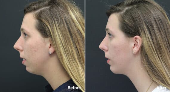 Chin Implants Before and After Photos in Princeton, NJ, Patient 831