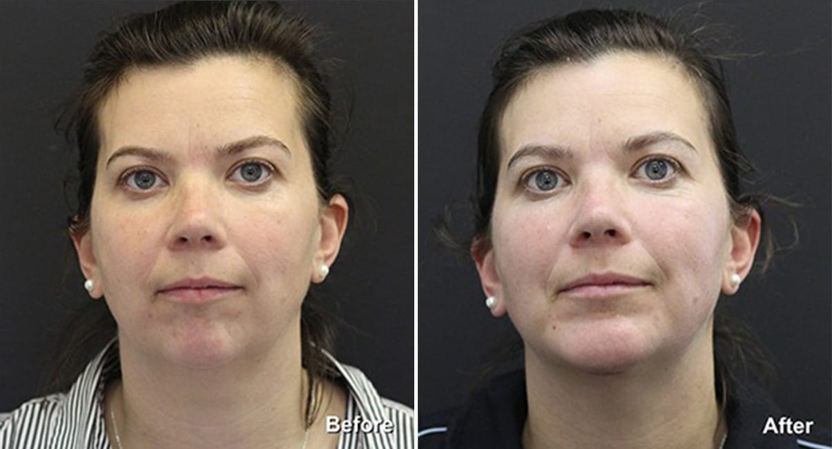 Chin Augmentation Before & After photos