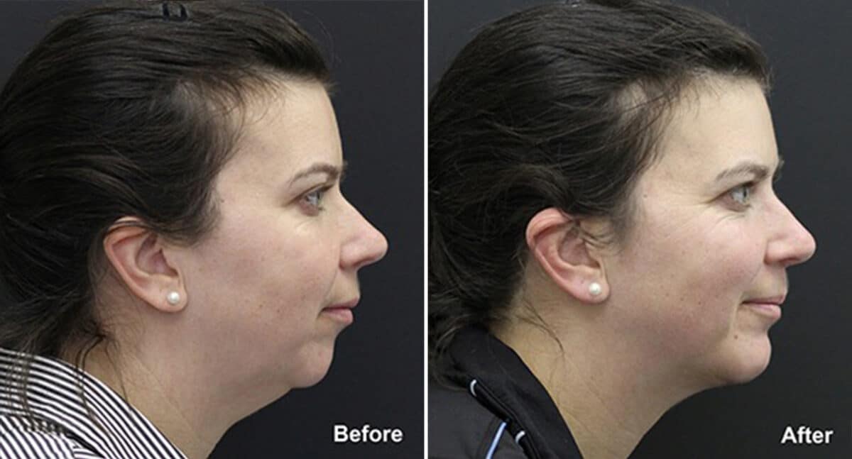 Chin Implants Before and After Photos in Princeton, NJ, Patient 838