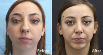 Chin Implants Before and After Photos in Princeton, NJ, Patient 848