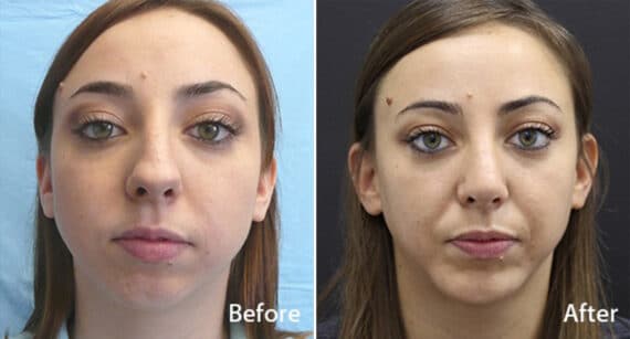 Chin Implants Before and After Photos in Princeton, NJ, Patient 848