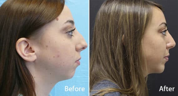 Chin Implants Before and After Photos in Princeton, NJ, Patient 848