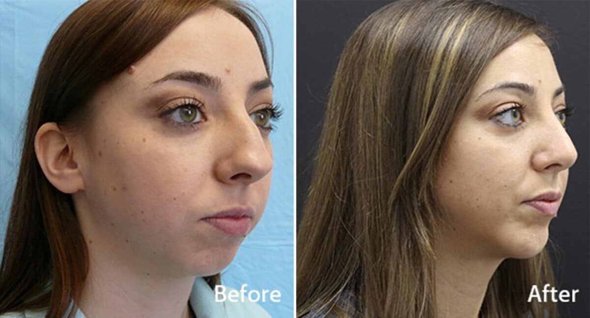 Patient 848, Chin Implants Before and After Photos Chin Implants Before and After Photos in Princeton, NJ, Patient 848