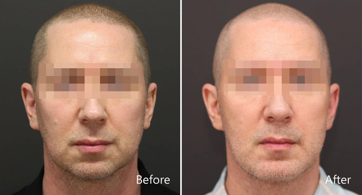 Chin Implants Before and After Photos in Princeton, NJ, Patient 868