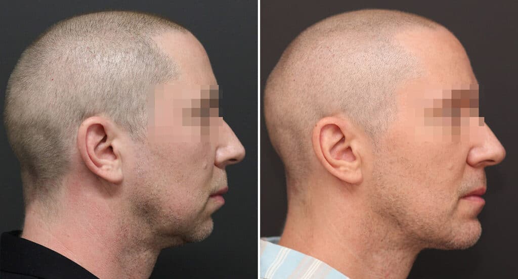 Chin Augmentation real patient