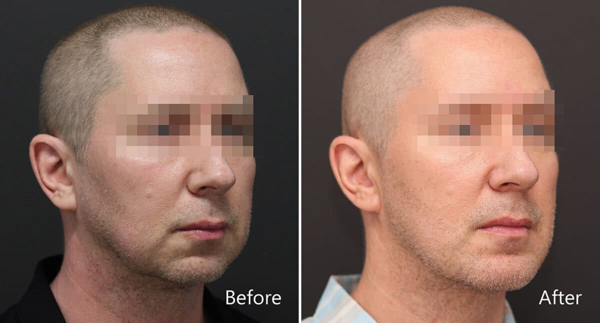 Chin Implants Before and After Photos in Princeton, NJ, Patient 868