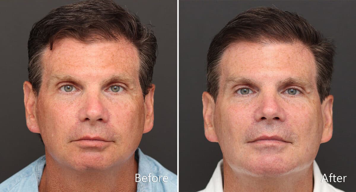 Chin Implants Before and After Photos in Princeton, NJ, Patient 887