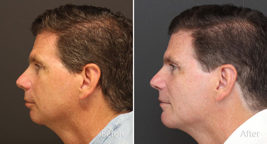 Improved chin projection and balanced facial profile after chin augmentation surgery.