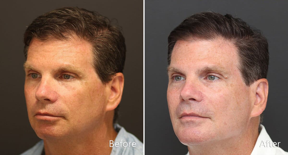 Chin Implants Before and After Photos in Princeton, NJ, Patient 887