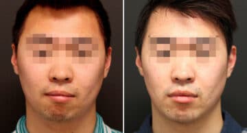 Chin Implants Before and After Photos in Princeton, NJ, Patient 897