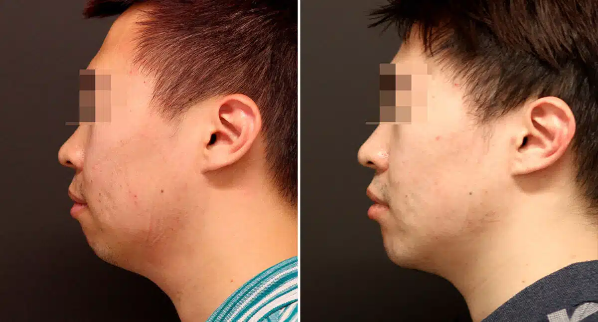 Chin Implants Before and After Photos in Princeton, NJ, Patient 897