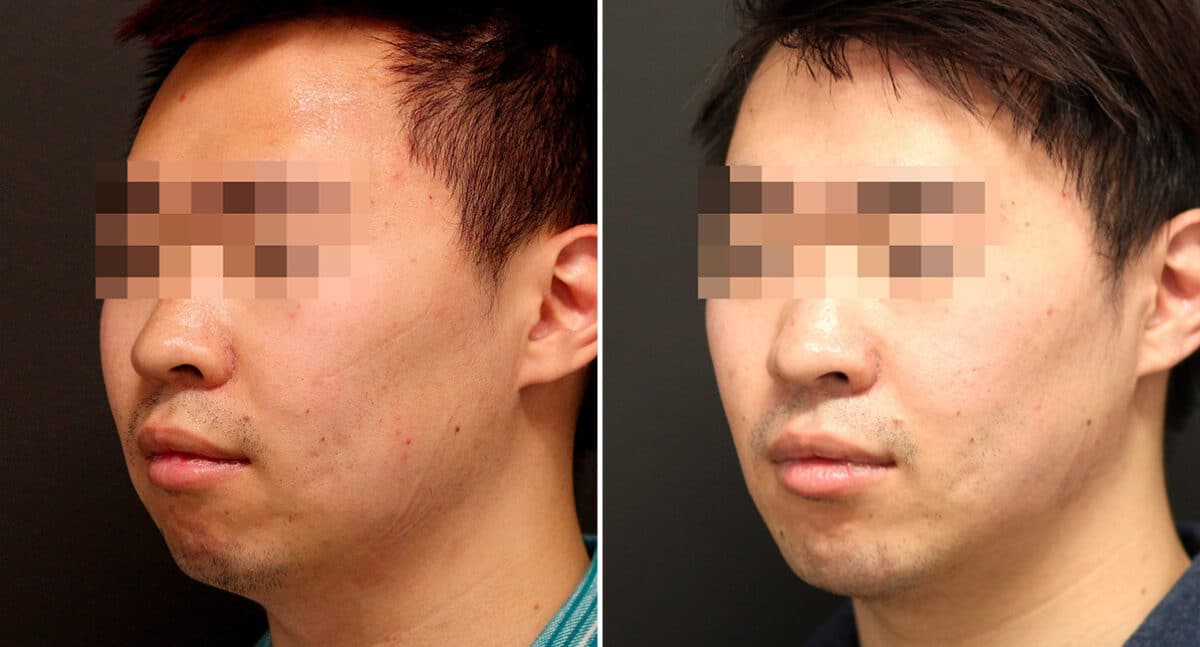 Chin Implants Before and After Photos in Princeton, NJ, Patient 897