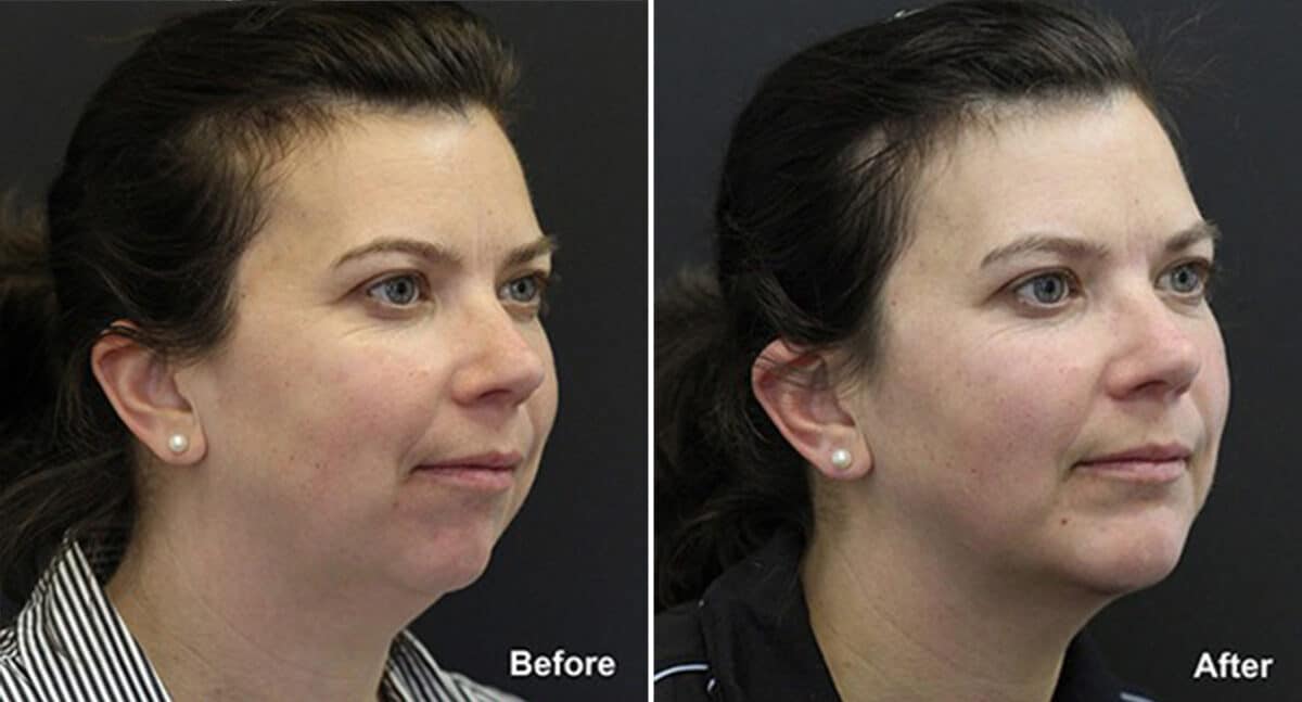 Chin Implants Before and After Photos in Princeton, NJ, Patient 838