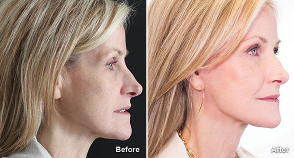 Facelift Before and After Photos in Princeton, NJ, Patient 190