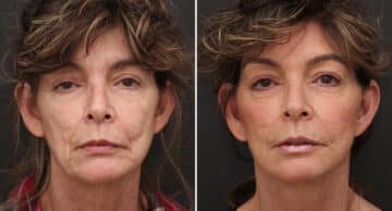 Facelift Before and After Photos in Princeton, NJ, Patient 203