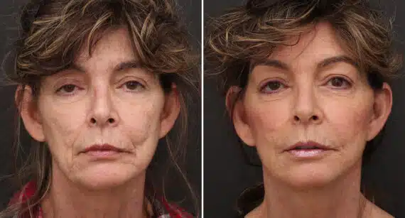 Facelift Before and After Photos in Princeton, NJ, Patient 203