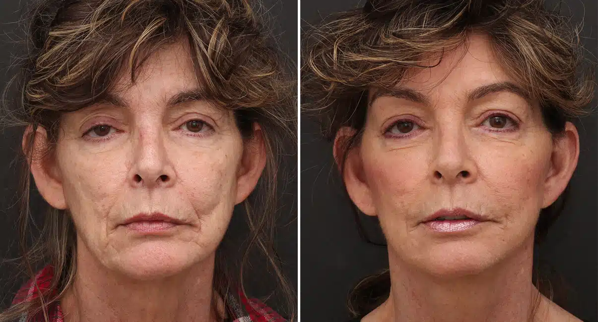 Facelift Before & After photos