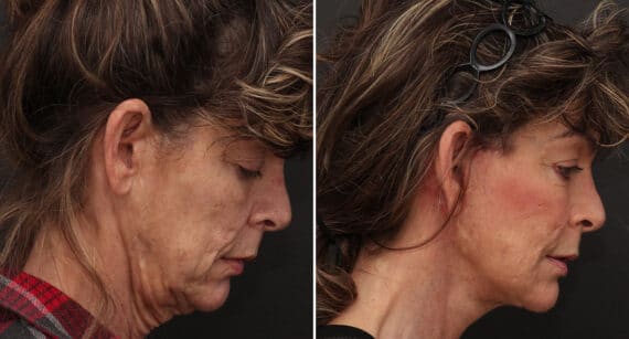 Facelift Before and After Photos in Princeton, NJ, Patient 203