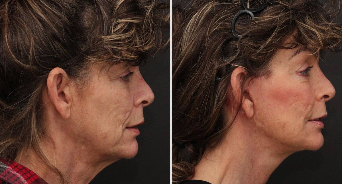 Facelift Before and After Photos in Princeton, NJ, Patient 203