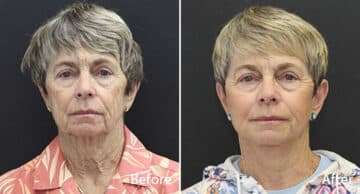 Facelift Before and After Photos in Princeton, NJ, Patient 213