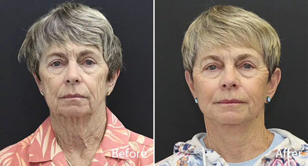 Facelift Before & After photos