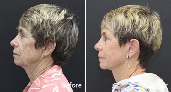 Facelift Before and After Photos in Princeton, NJ, Patient 213