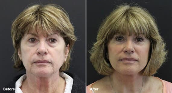 Facelift Before and After Photos in Princeton, NJ, Patient 223