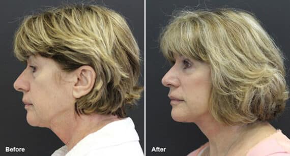 Facelift Before and After Photos in Princeton, NJ, Patient 223