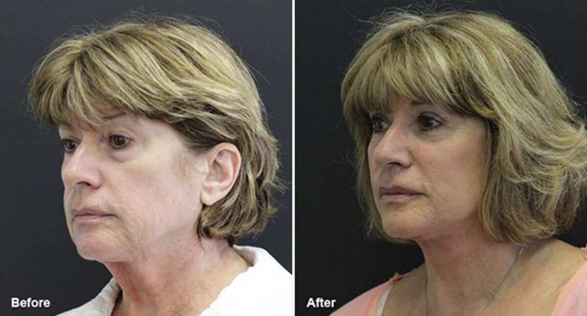 Facelift Before and After Photos in Princeton, NJ, Patient 223