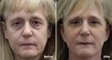 Facelift Before and After Photos in Princeton, NJ, Patient 233