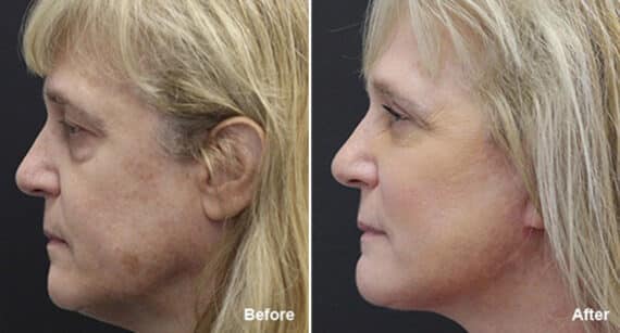 Facelift Before and After Photos in Princeton, NJ, Patient 233