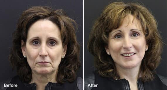 Facelift Before and After Photos in Princeton, NJ, Patient 243