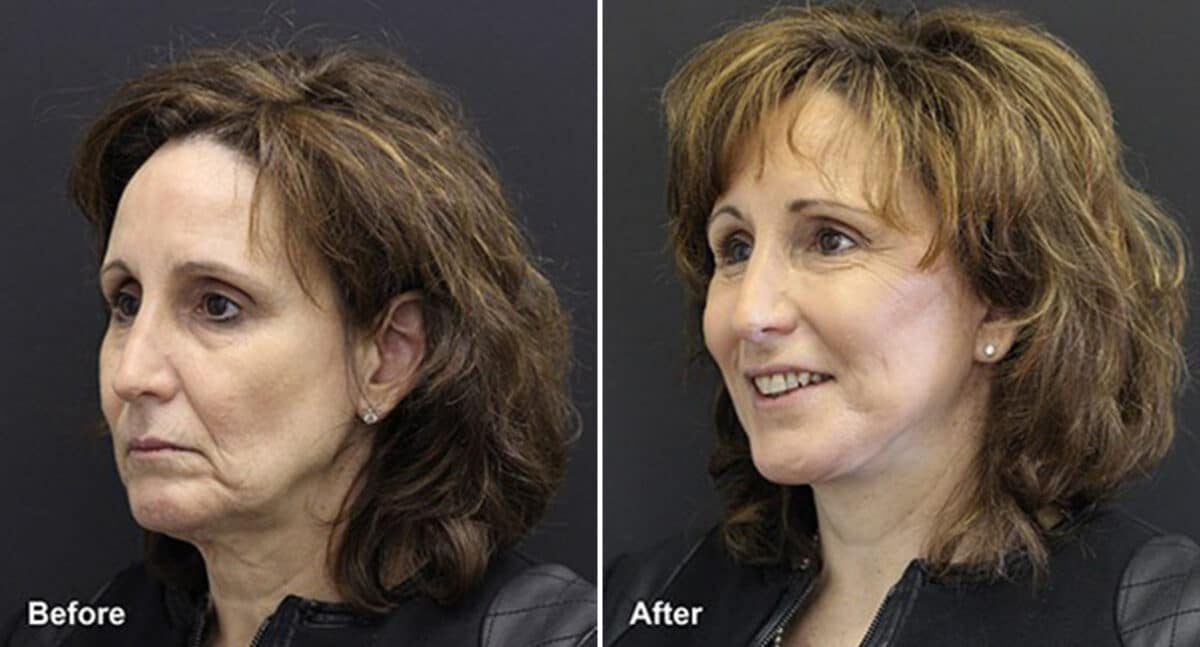 Facelift Before and After Photos in Princeton, NJ, Patient 243