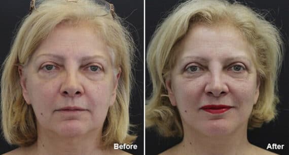 Facelift Before and After Photos in Princeton, NJ, Patient 250