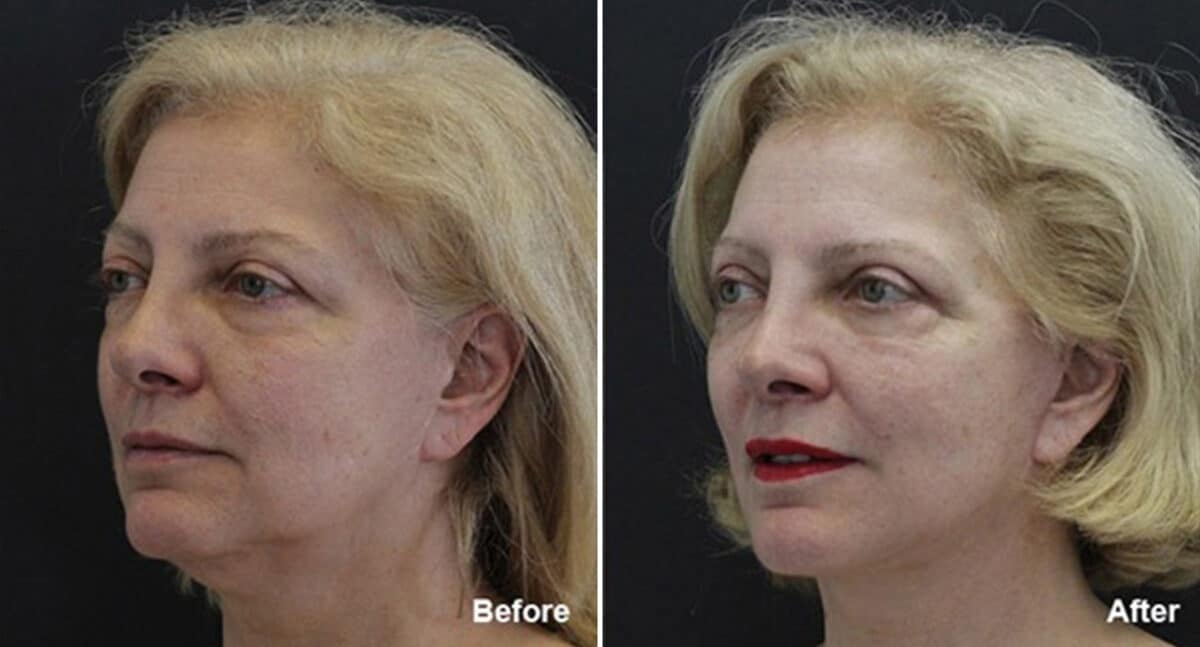 Facelift Before and After Photos in Princeton, NJ, Patient 250