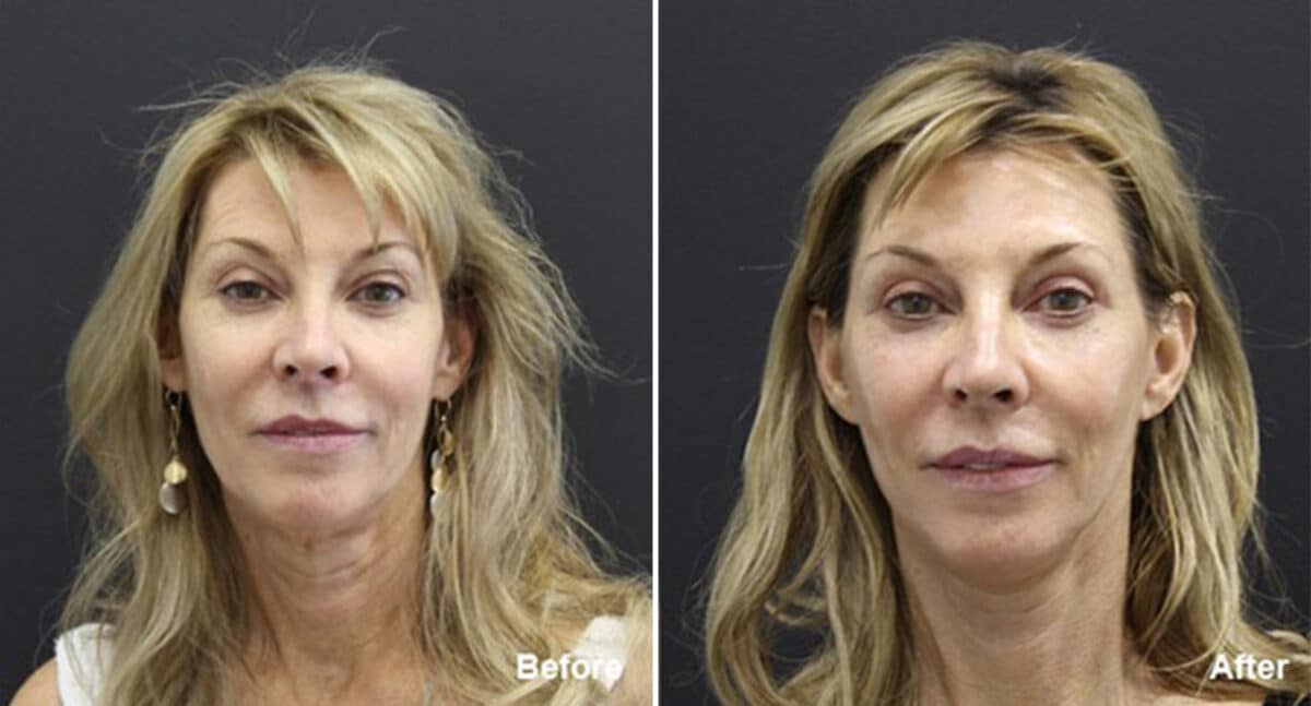 Facelift Before and After Photos in Princeton, NJ, Patient 257