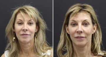 Facelift Before and After Photos in Princeton, NJ, Patient 257