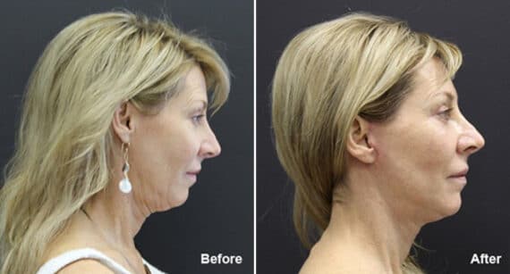 Facelift Before and After Photos in Princeton, NJ, Patient 257