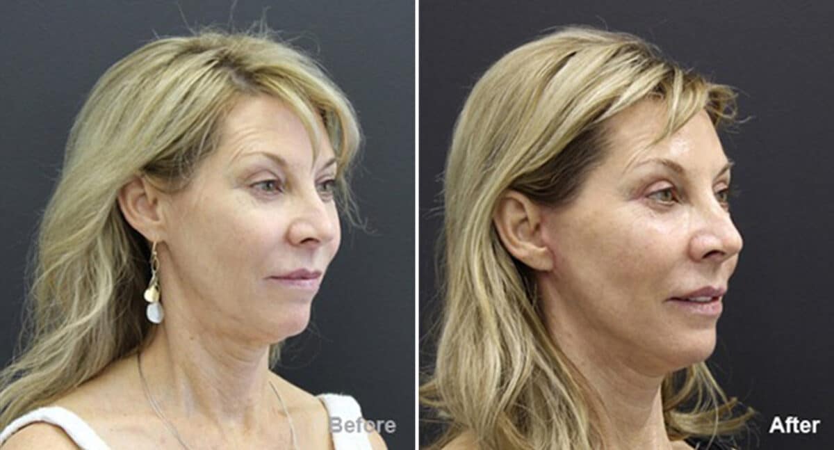 Facelift Before and After Photos in Princeton, NJ, Patient 257